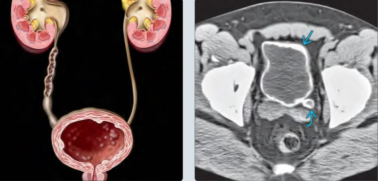 На компьютерной томографии (КТ) органов малого таза визуализируется поражение мочеточника и мочевого пузыря.